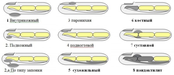 Панариций: причины, симптомы, виды, лечение дома и народными средствами