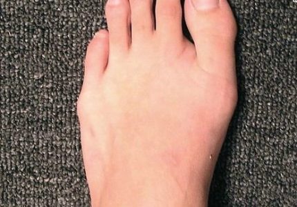 Второй палец на ноге длиннее большого
