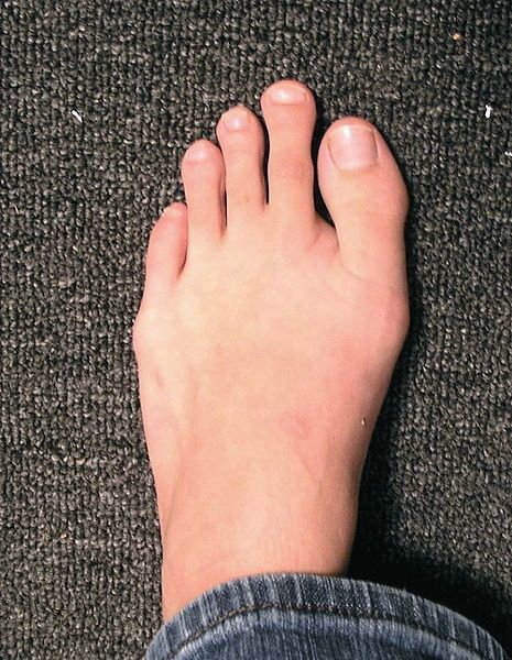 Второй палец на ноге длиннее большого: наследственность или случайность?